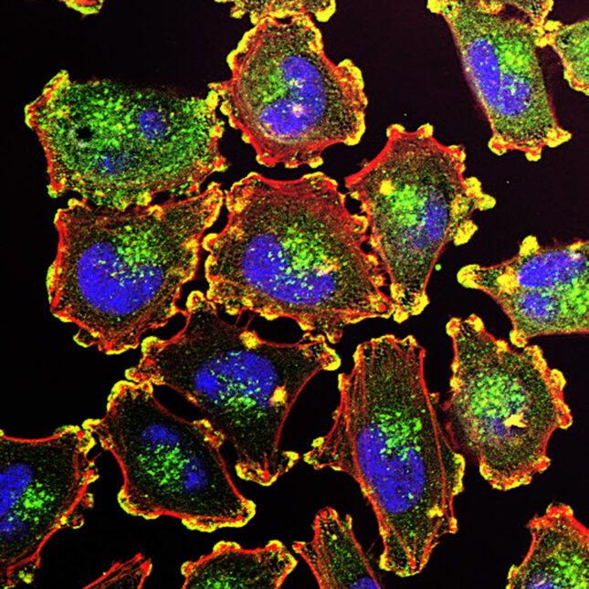 The ability of cancer cells to move and spread depends on actin-rich core structures such as the podosomes (yellow) shown here in melanoma cells. Cell nuclei (blue), actin (red), and an actin regulator (green) are also shown.