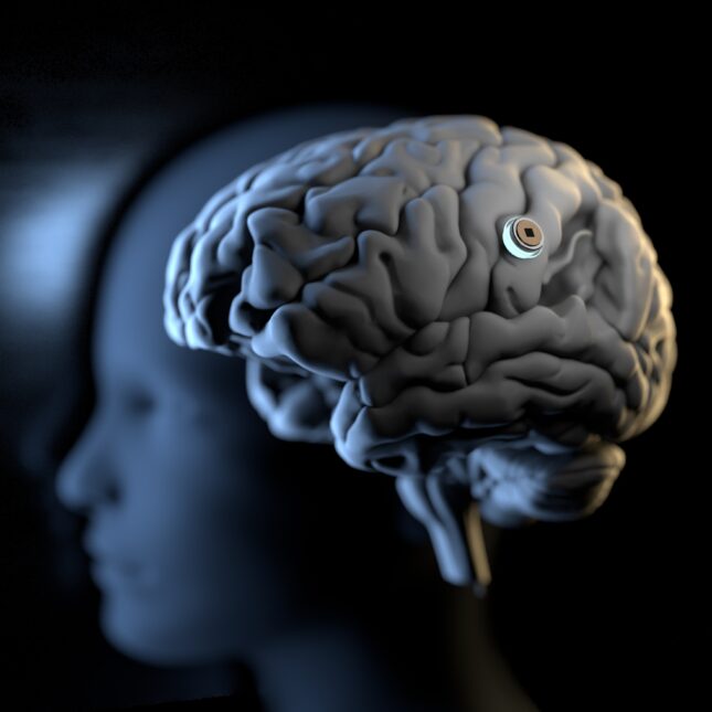3D render of a brain chip inserted into a brain foregrounding a person's side face — first opinion coverage from STAT