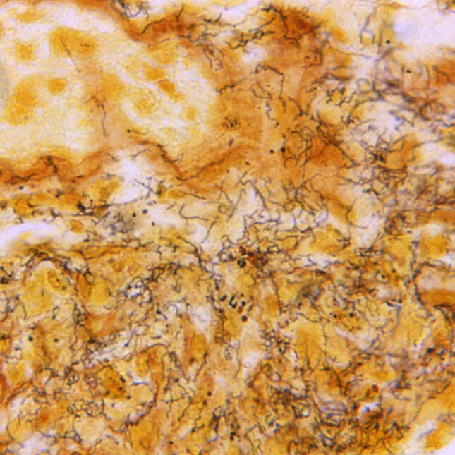 This 1966 microscope photo shows a tissue sample with the presence of numerous, corkscrew-shaped, darkly-stained, Treponema pallidum spirochetes, the bacterium responsible for causing syphilis. -- Health coverage from STAT