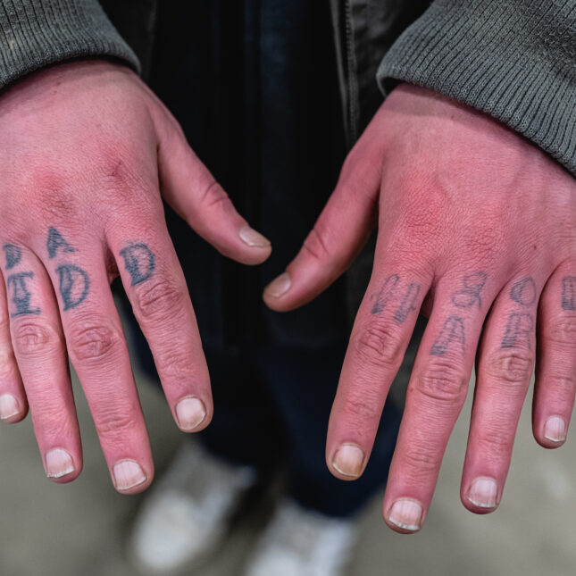 A man, who is suffering from frostbite, displays his hands. -- health coverage from STAT